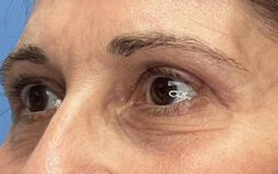 Blepharoplasty Before & After Image