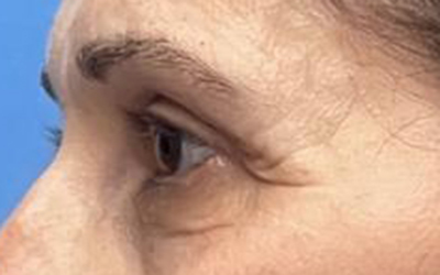 Blepharoplasty Before & After Image