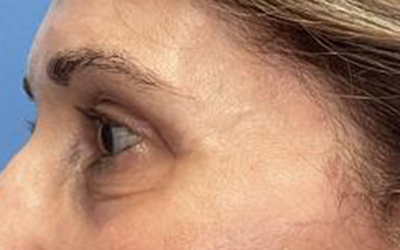 Blepharoplasty Before & After Image