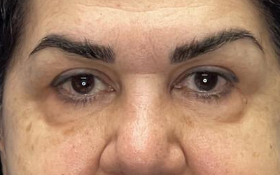 Blepharoplasty Before & After Image