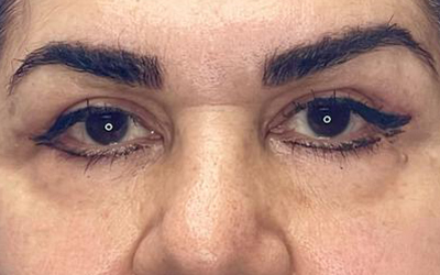 Blepharoplasty Before & After Image