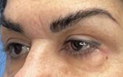 Blepharoplasty Before & After Image