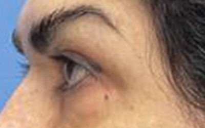 Blepharoplasty Before & After Image