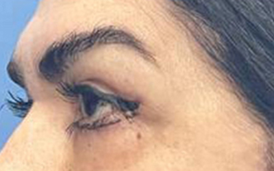 Blepharoplasty Before & After Image