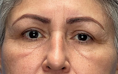 Blepharoplasty Before & After Image