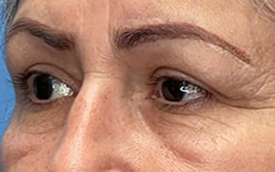 Blepharoplasty Before & After Image