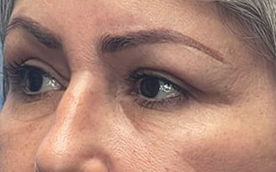 Blepharoplasty Before & After Image