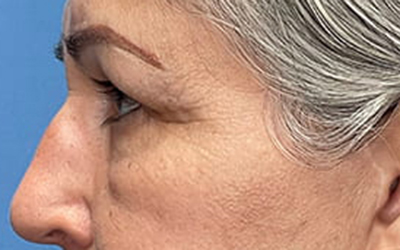 Blepharoplasty Before & After Image