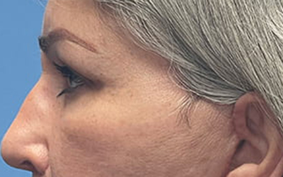 Blepharoplasty Before & After Image