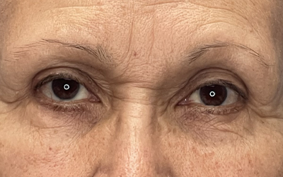 Blepharoplasty Before & After Image