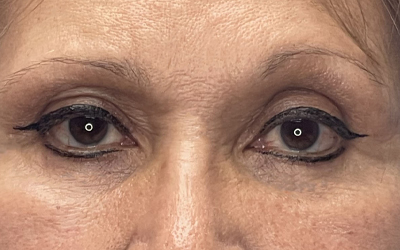 Blepharoplasty Before & After Image