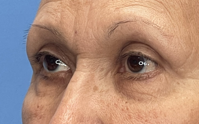 Blepharoplasty Before & After Image