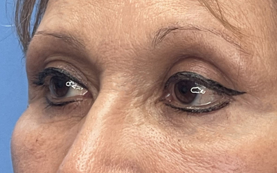 Blepharoplasty Before & After Image