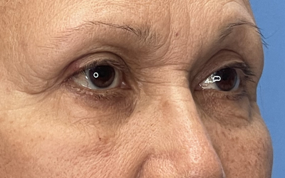 Blepharoplasty Before & After Image