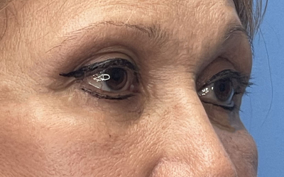 Blepharoplasty Before & After Image