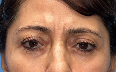 Blepharoplasty Before & After Image