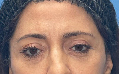 Blepharoplasty Before & After Image