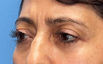 Blepharoplasty Before & After Image