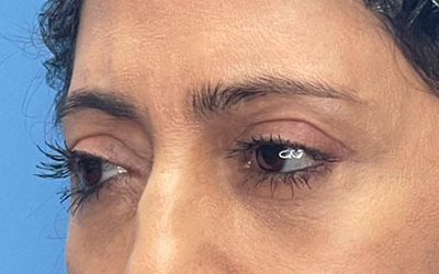 Blepharoplasty Before & After Image