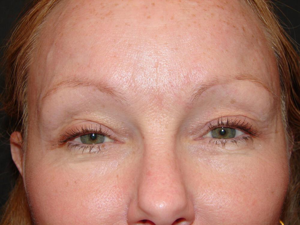 Brow Lift Before & After Image