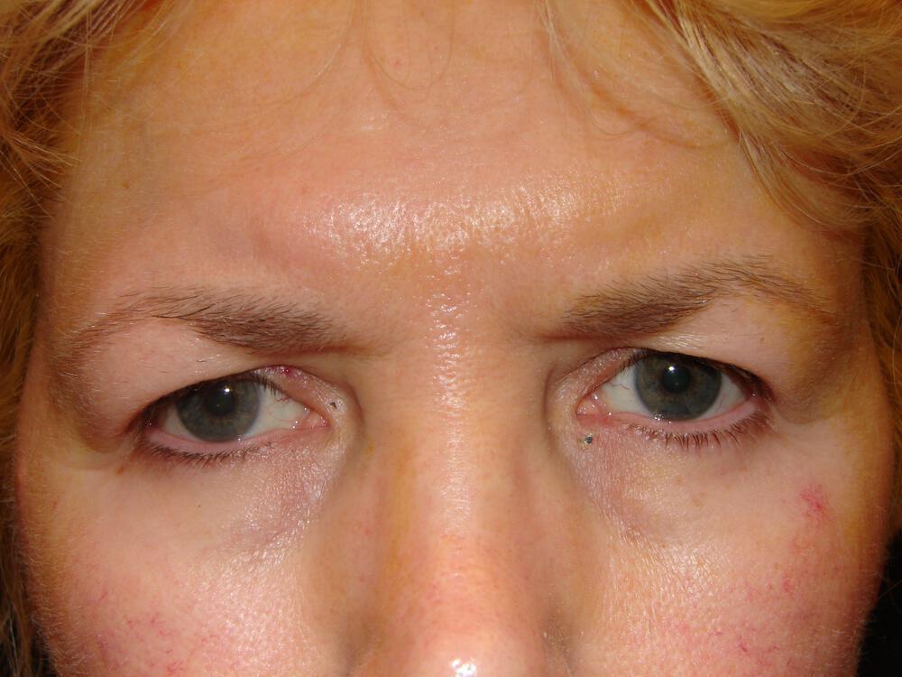 Brow Lift Before & After Image