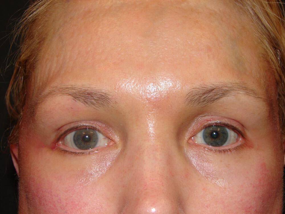 Brow Lift Before & After Image