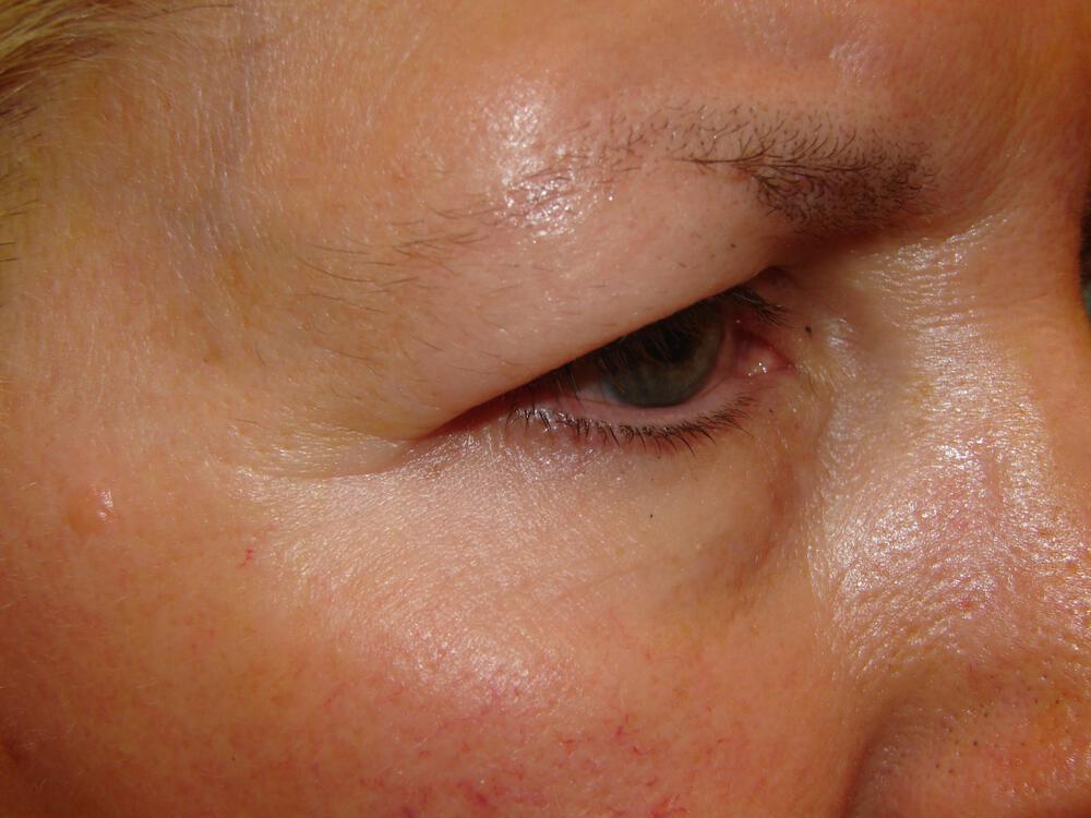 Brow Lift Before & After Image