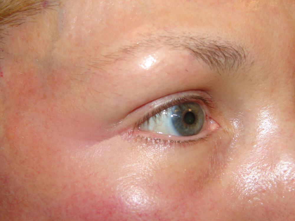 Brow Lift Before & After Image