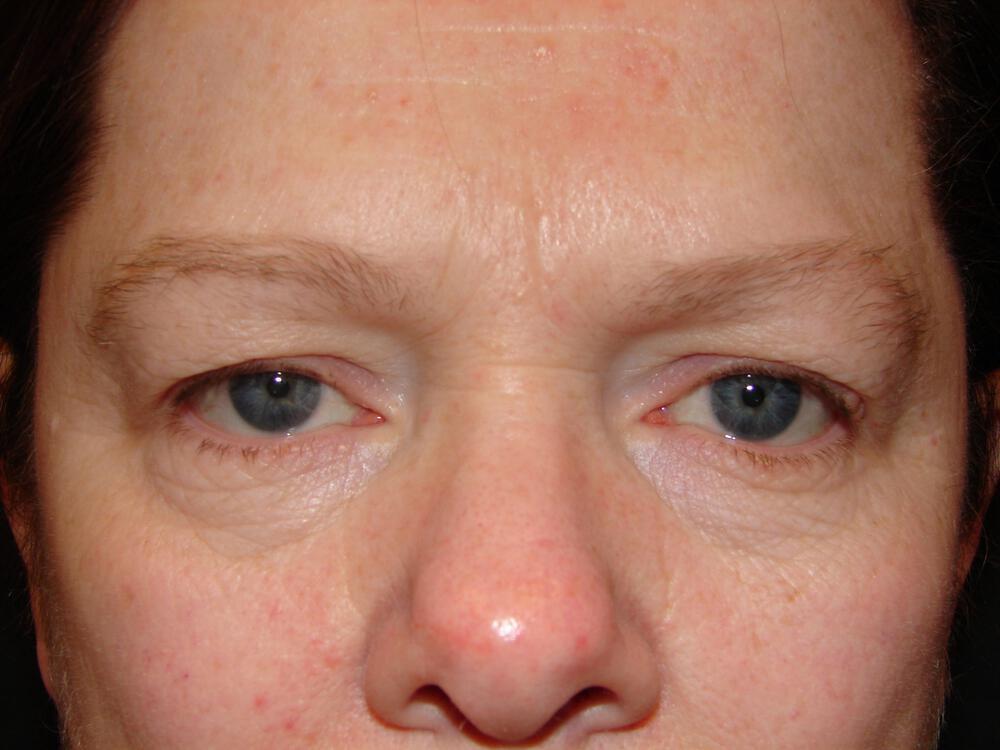 Brow Lift Before & After Image