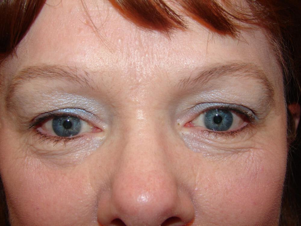 Brow Lift Before & After Image