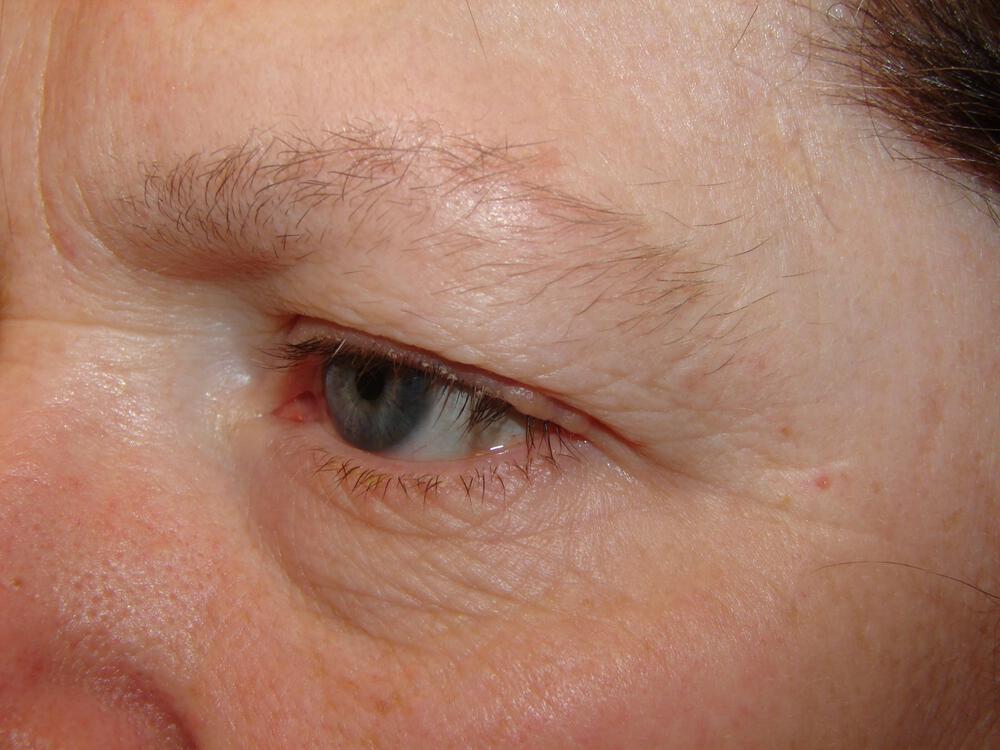 Brow Lift Before & After Image