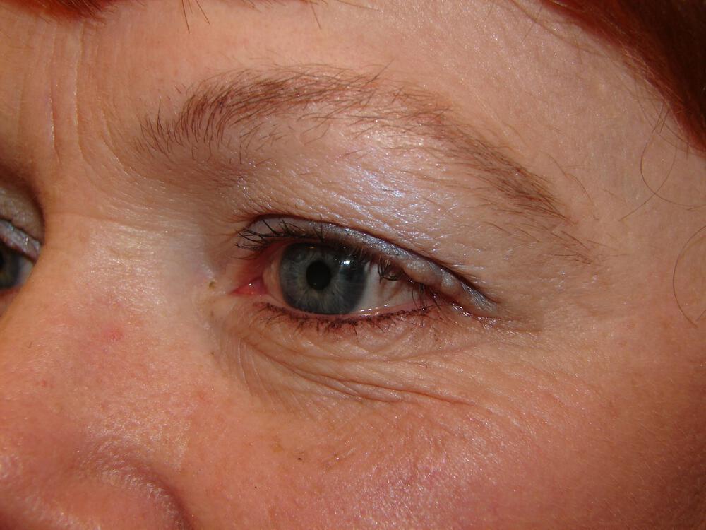 Brow Lift Before & After Image