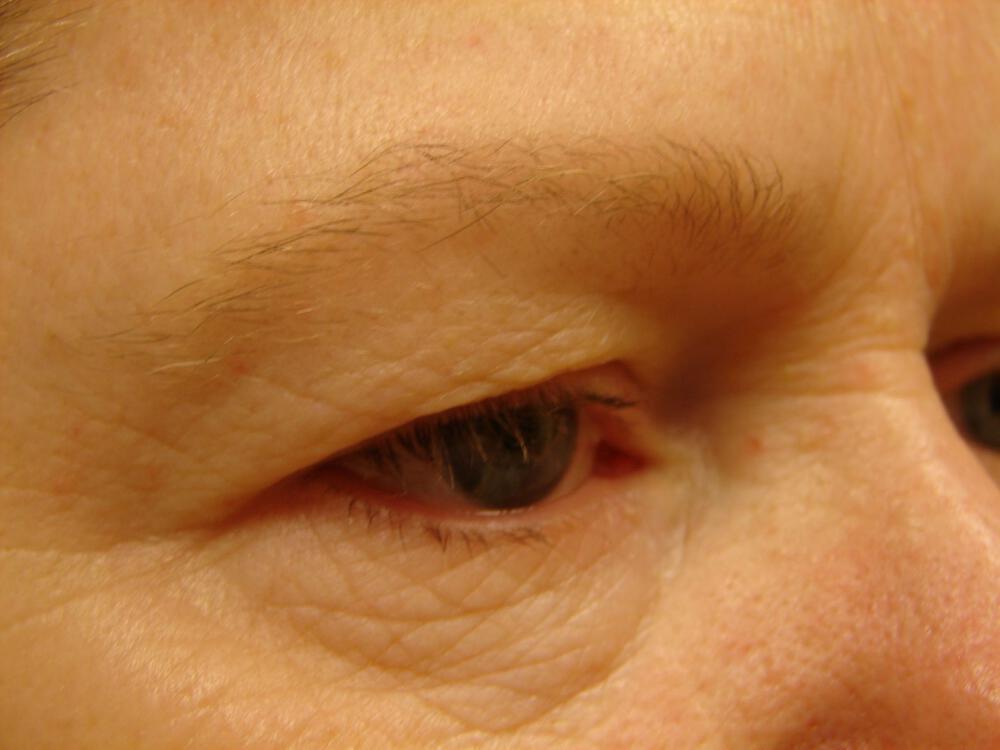 Brow Lift Before & After Image