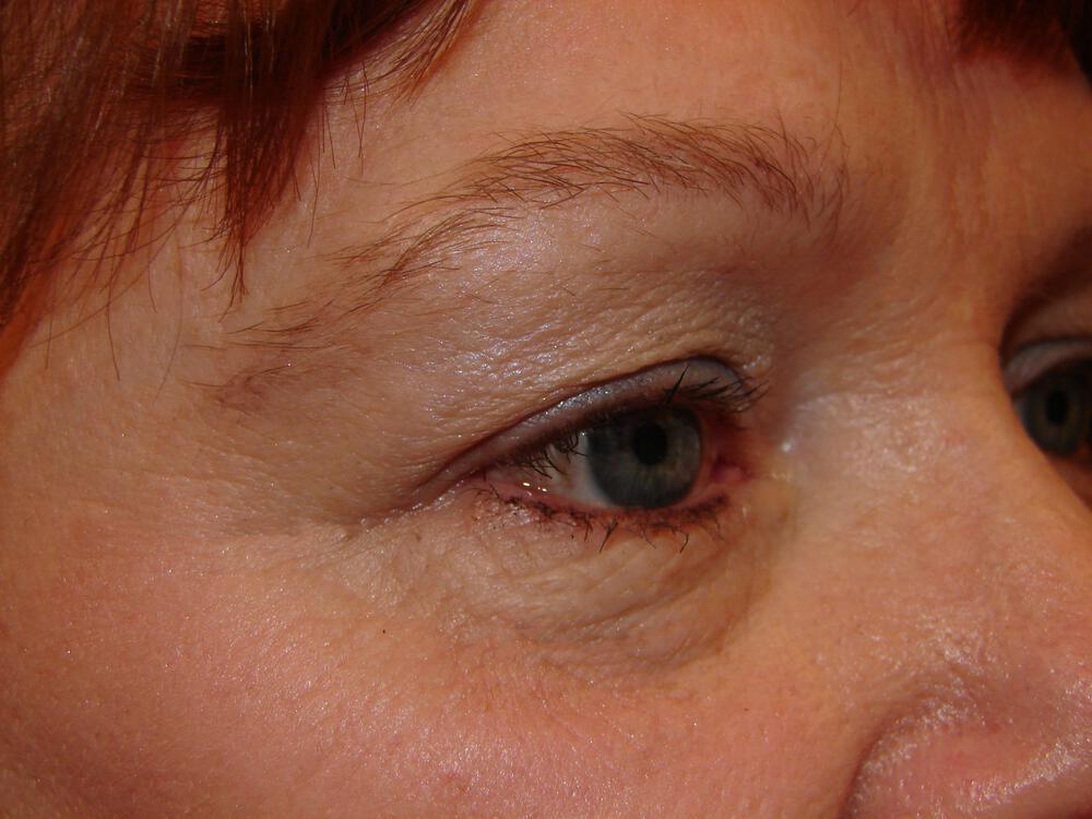 Brow Lift Before & After Image