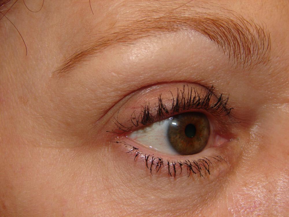 Brow Lift Before & After Image