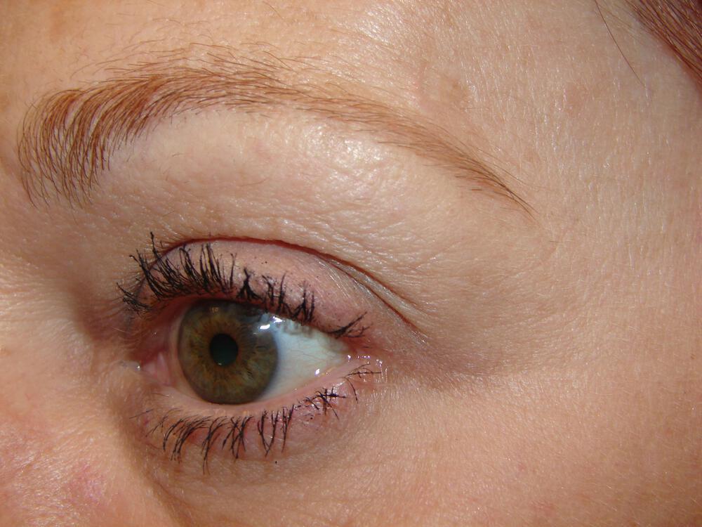 Brow Lift Before & After Image