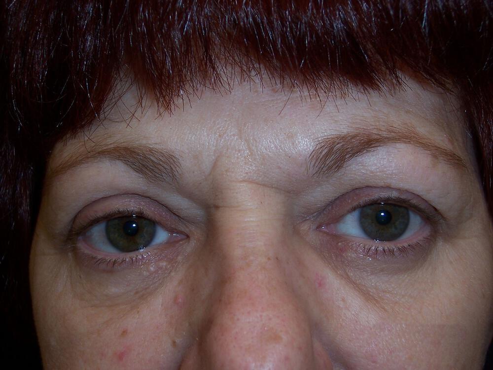 Brow Lift Before & After Image