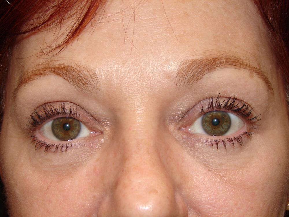 Brow Lift Before & After Image