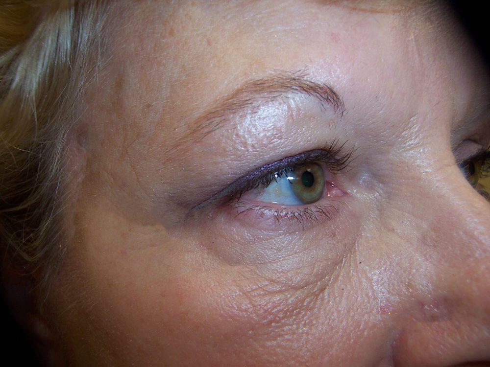 Brow Lift Before & After Image