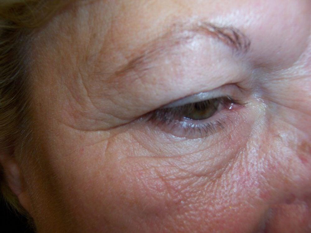 Brow Lift Before & After Image