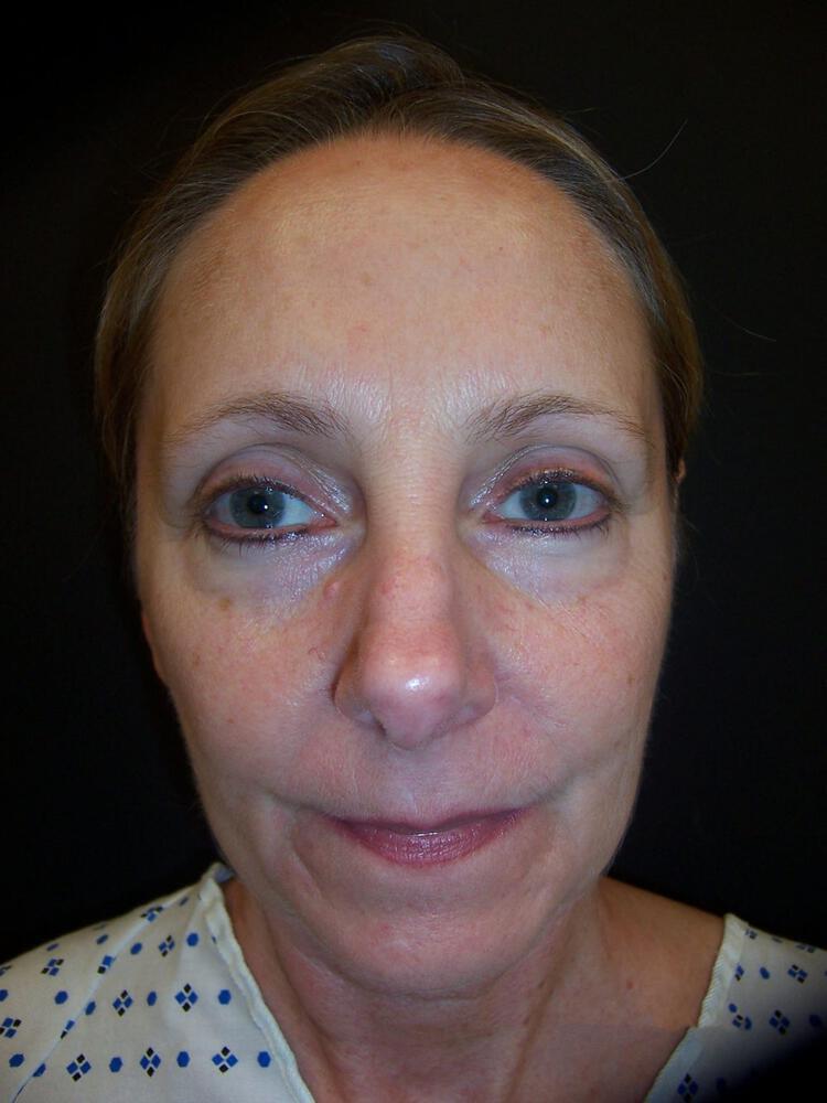 Brow Lift Before & After Image