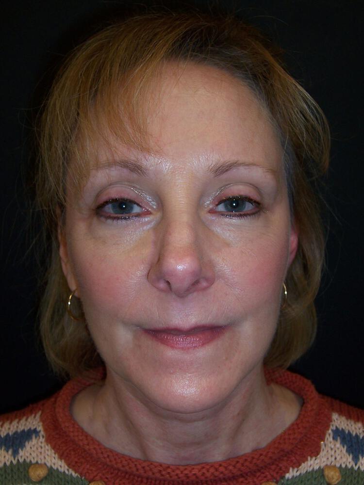 Brow Lift Before & After Image