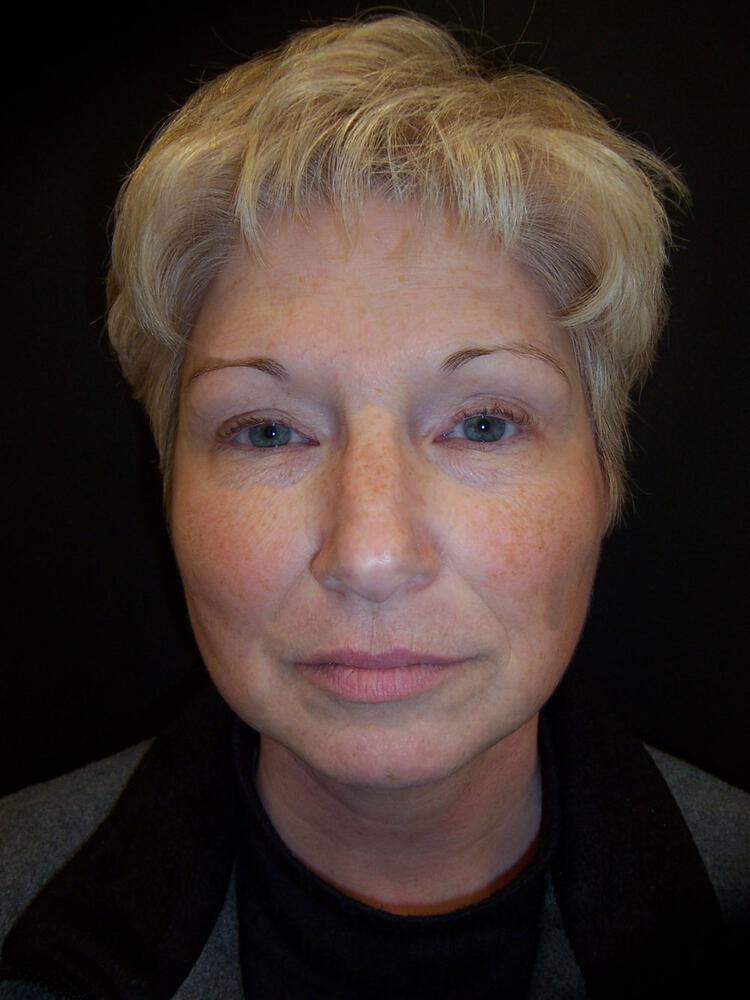 Brow Lift Before & After Image