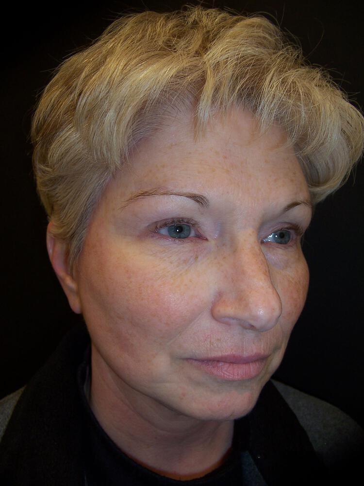 Brow Lift Before & After Image