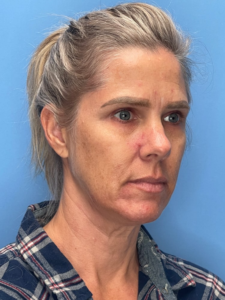 Brow Lift Before & After Image