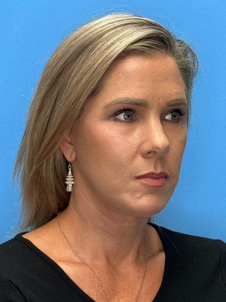 Brow Lift Before & After Image