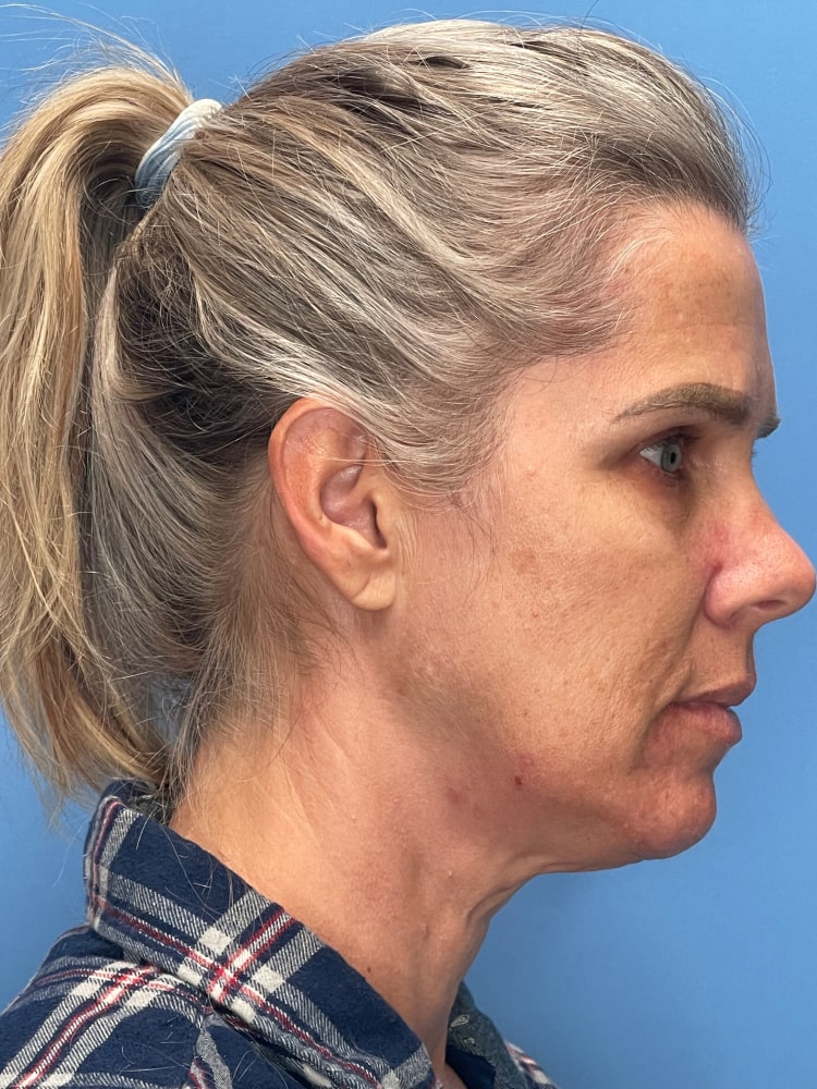 Brow Lift Before & After Image