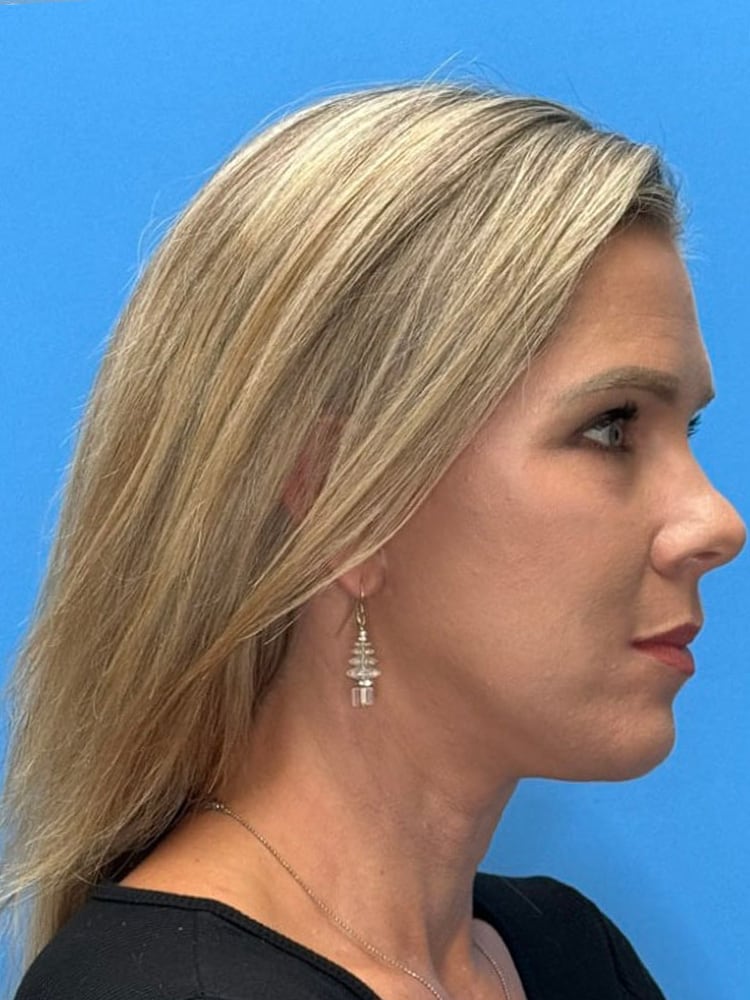 Brow Lift Before & After Image