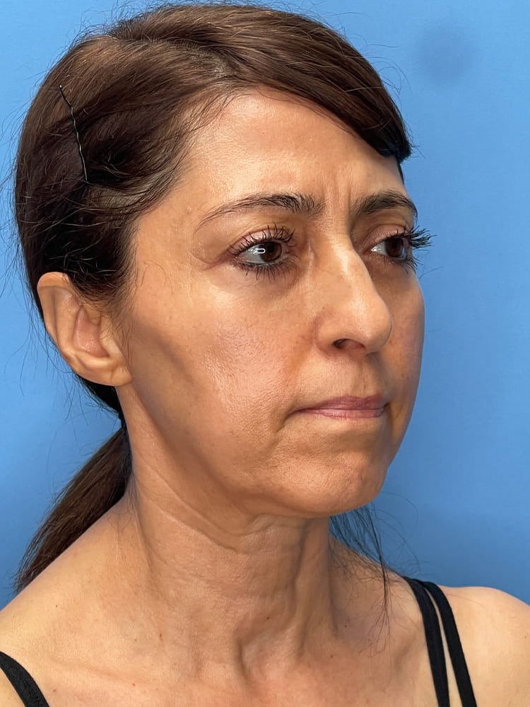 Brow Lift Before & After Image