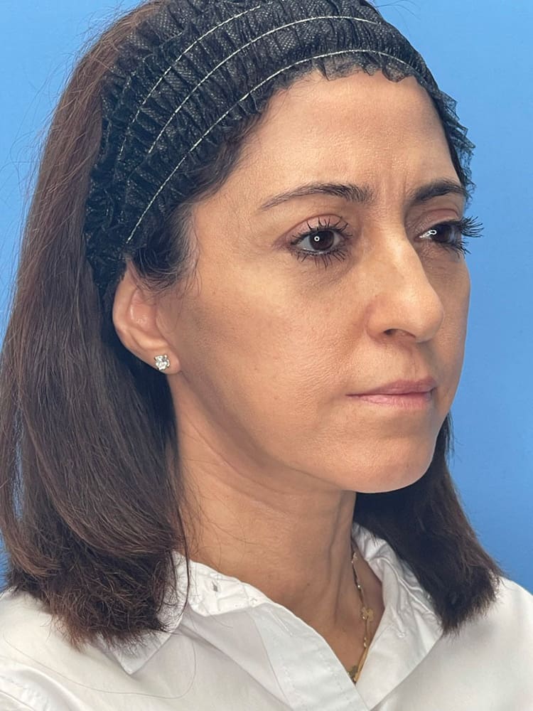 Brow Lift Before & After Image